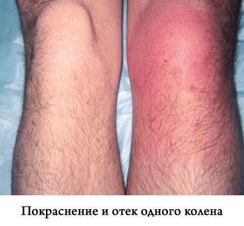 покраснение и отек одного колена