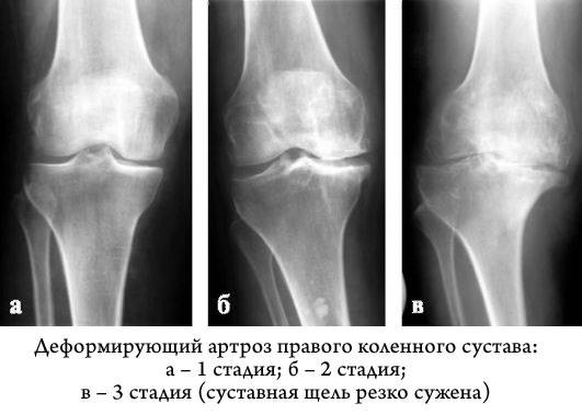 три степени деформирующего артроза степени деформирующего артроза