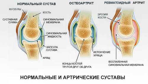 Какие виды артрита выделяют врачи на текущий момент