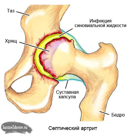 септический артрит