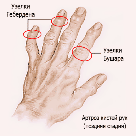 узелки Гебердена и Бушара узелки Гебердена и Бушара