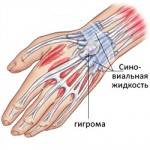 гигрома - схема