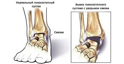 Вывих голеностопного сустава