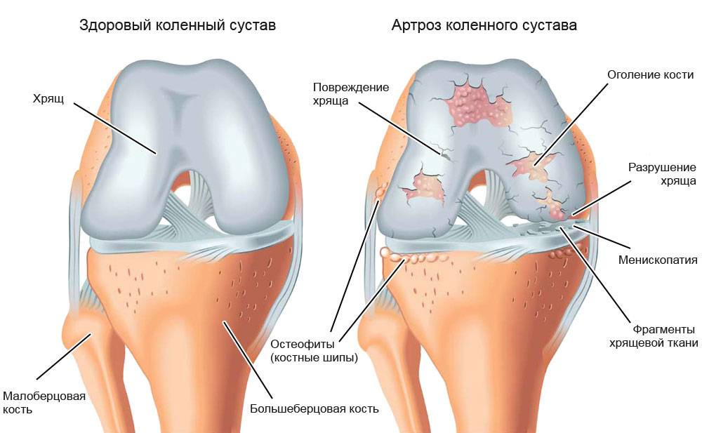 Деформирующий остеоартроз 2 степени коленного сустава