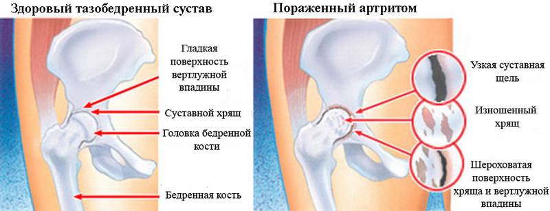 Сустав пораженный артритом