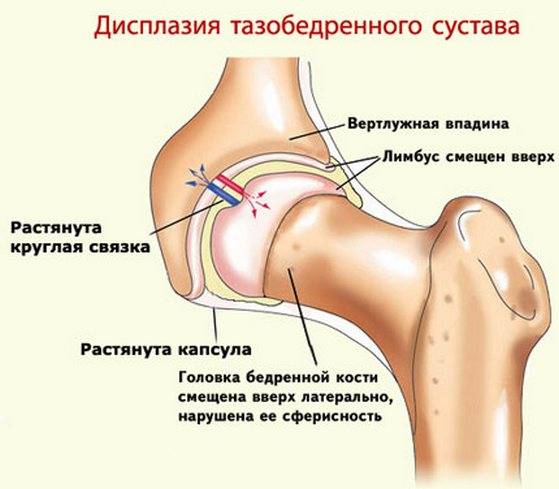 Дисплазия ТБС Дисплазия тазобедренного сустава
