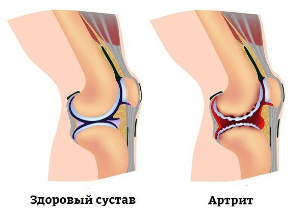 признаки артрита