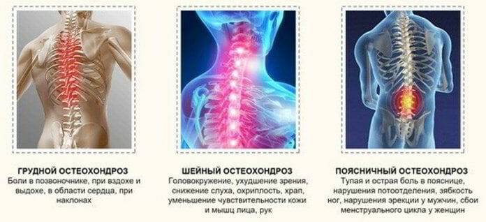 Остеохондроз