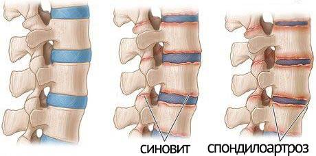 Механизм развития вторичного спондилоартроза