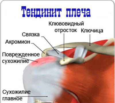 Тендинит плеча