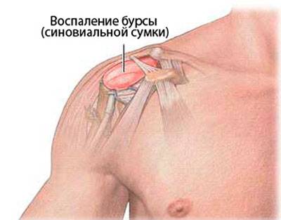 Воспаление бурсы