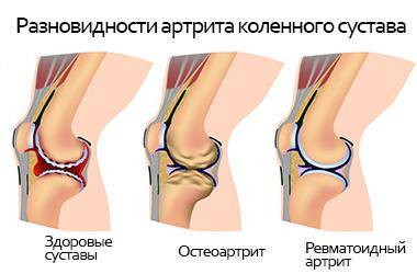Артрит коленного сустава признаки