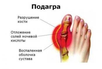Приступы подагры симптомы