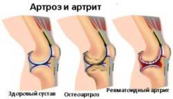 чаще всего боль в суставах обусловлена остеоартрозом