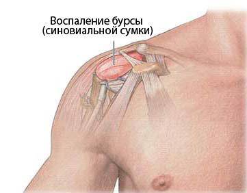Бурсит плечевого сустава