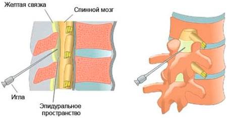 Периартикулярная блокада