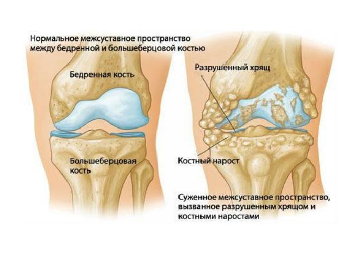 Проблема деформирующего артроза Проблема деформирующего артроза