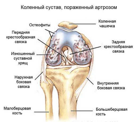 Изменнения при артрозе коленного сустава Изменнения при артрозе коленного сустава