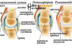 Симптомы и причины боли в коленном суставе