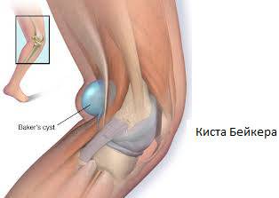 Киста Беккера