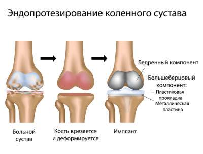 Эндопротезирование коленного сустава