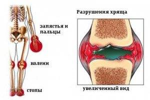 Особенности ревматоидного артрита