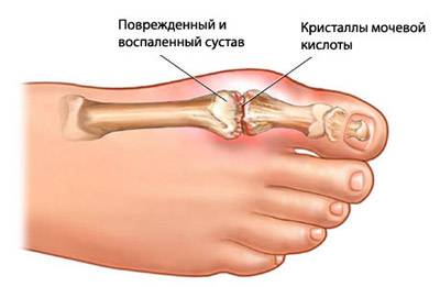 Подагра