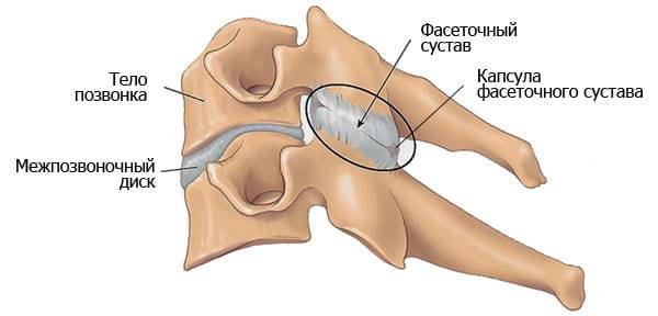 лечение спондилоартроза