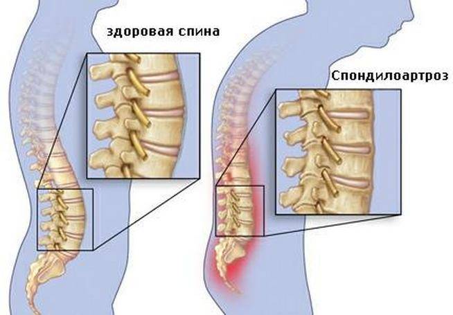 развитие спондилоартроза