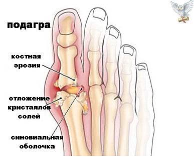 подагра - причины, симптомы