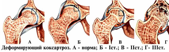Стадии заболевания