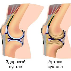 Здоровый и больной суставы
