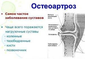 деформирующий остеоартроз