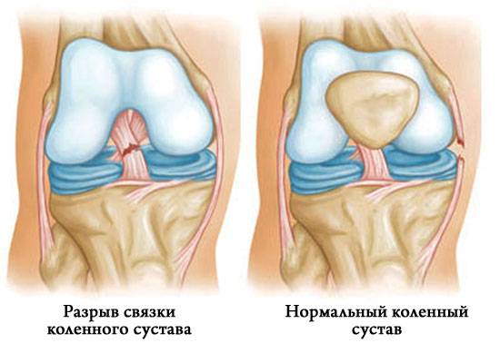 разрыв связок коленного сустава