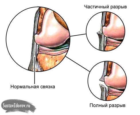 частичный и полный разрывы связок коленного сустава