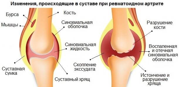 Ревматоидный артрит изменения в суставе