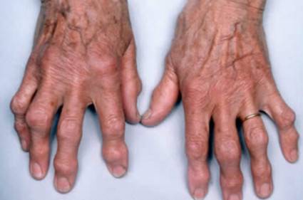 Деформирующий артроз