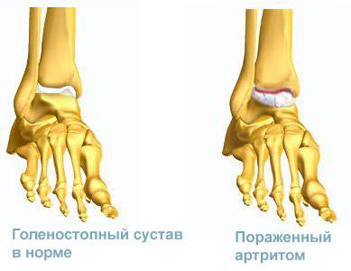 Артрит голеностопного сустава