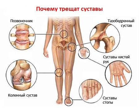 Артрит и артроз (заболевания суставов) - отличие и как лечить
