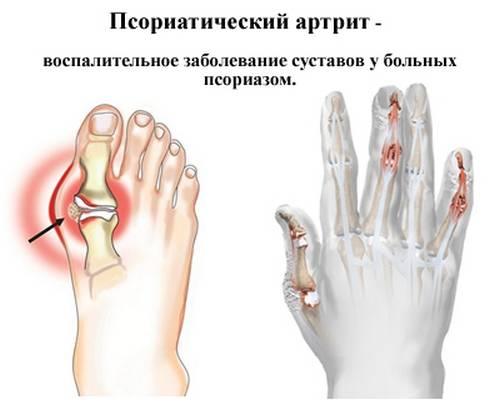 псориатический артрит