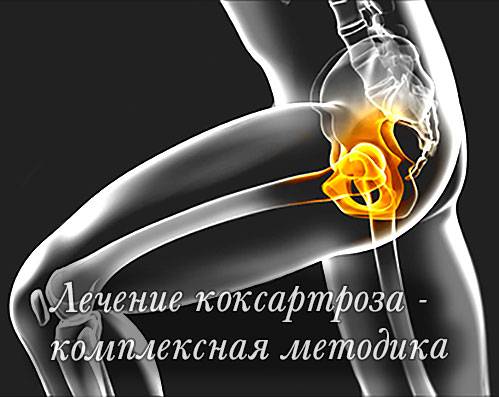 Метод лечения коксартроза