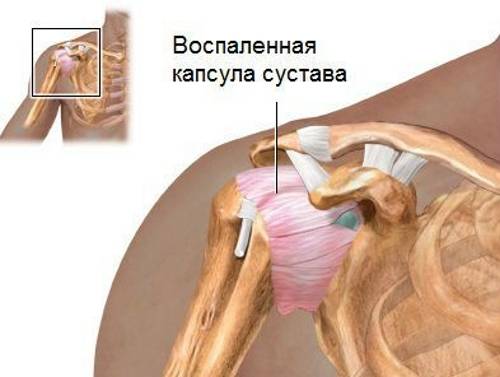 Воспаление плечелопаточной капсулы сустава при периартрозе Воспаление плечелопаточной капсулы сустава при периартрозе