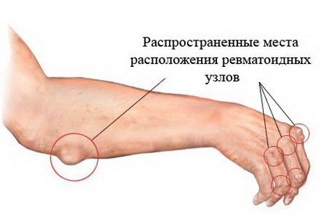 Подкожные ревматические узелки Подкожные ревматические узелки