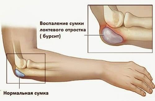 воспаление локтя при бурсите воспаление локтя при бурсите