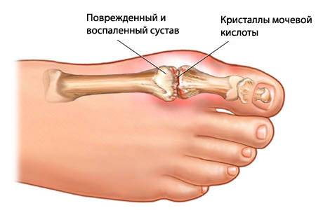 Как лечить подагру народными средствами на ногах