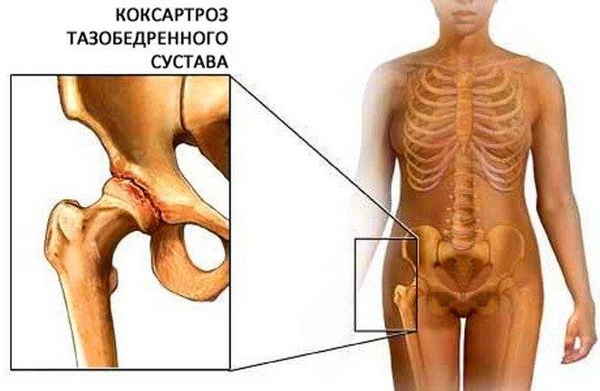 Коксартроз тазобедренного сустава Коксартроз тазобедренного сустава
