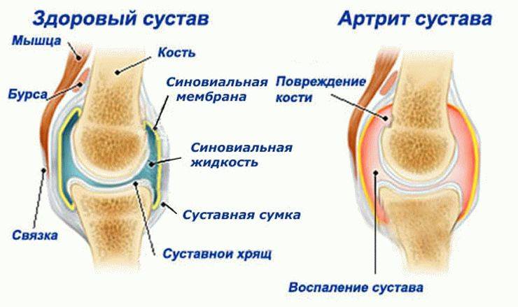 артрит суставов артрит суставов