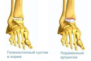 Что такое голеностопный артрит