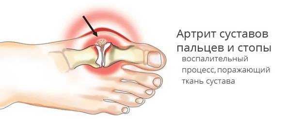 Артрит суставов пальцев и стопы