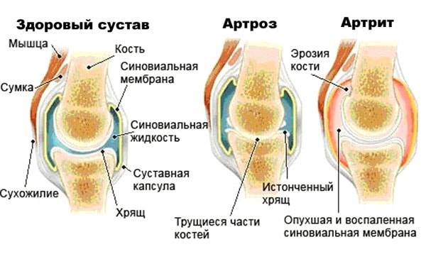 Артроз остеохондроз